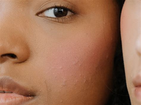 acne care solution hera beaute