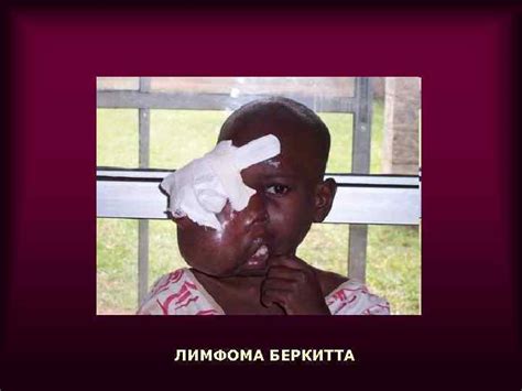 ЛЕКЦИЯ ГЕРПЕСВИРУСЫ. ОБЩАЯ