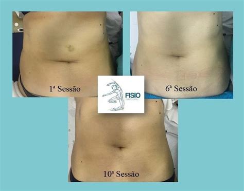 Radiofrequência Antes E Depois Barriga - Conseguem perceber as diferenças? 😱 Tratamento de radiofrequência em 10 ...