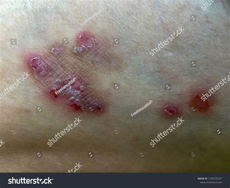 scab skin dermatology stock photo  shutterstock