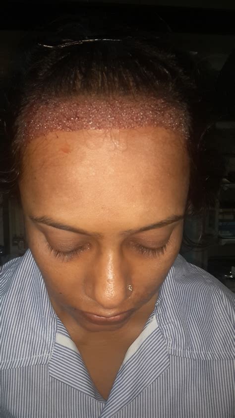Prime Hair Studio & Cosmetic Clinic : Female Hair Transplant Near Me
