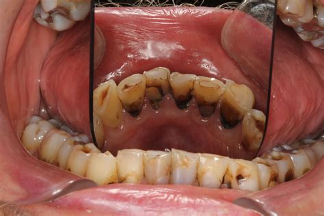 Xerostomia Caries And