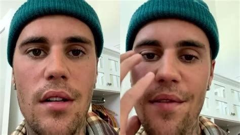 Doença Do Justin Bieber - Saiba o que é Ramsay Hunt, síndrome que afetou rosto de Justin Bieber ...