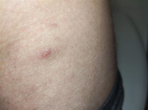 Was für einen Krankheit liegt bei diesem Hautausschlag vor? (Gesundheit