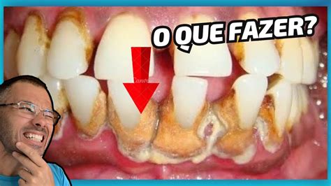 O Que São Tartaros - O QUE SÃO TÁRTAROS? COMO TIRAR EM CASA? FAÇA ISSO! - YouTube