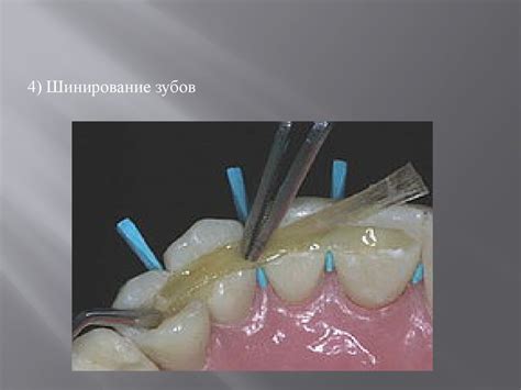 Замещение дефектов коронки зуба коронковыми вкладками - online presentation