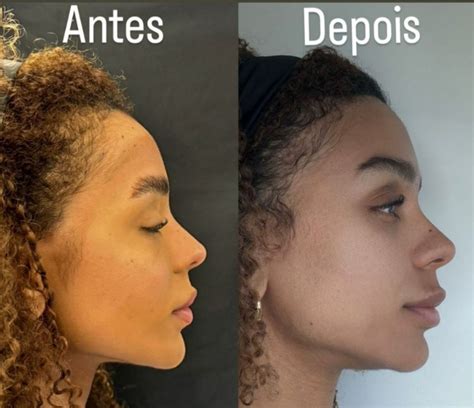 Frontoplastia O Que É