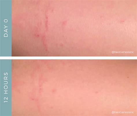 Allergic Reaction to Henna Tattoo: Before + After