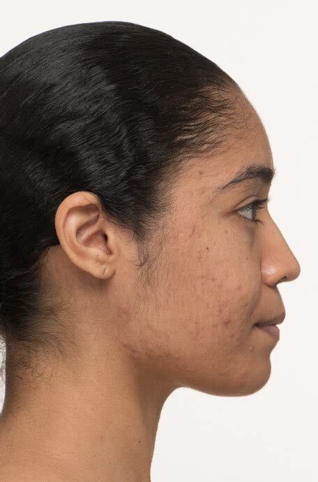 Nutrafol Skin Results - Before & After Acne Progress | Nutrafol Skin