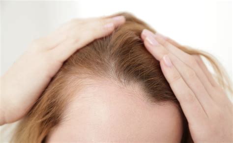 Hair Loss and Thyroid - Dynamic Life Health Center