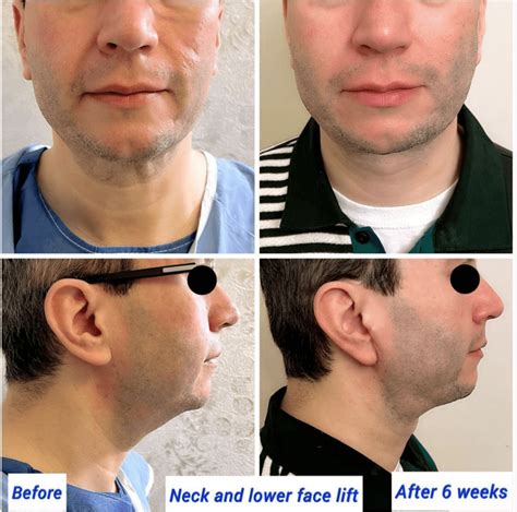 facelift men   incredible results london uk