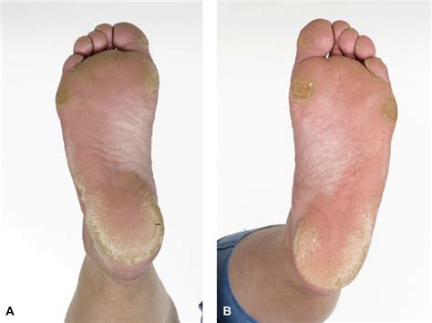 More than meets the eye: Palmoplantar keratoderma and arrhythmogenic