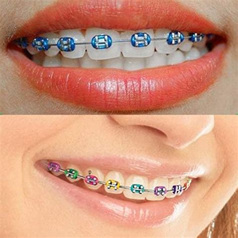 blue braces rubber bands  jimmy coats blog