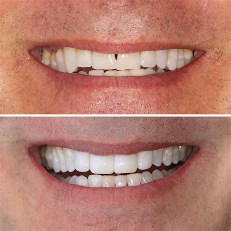 Direct Resin Veneers - Studio City, CA | Dr. Jamie Sands