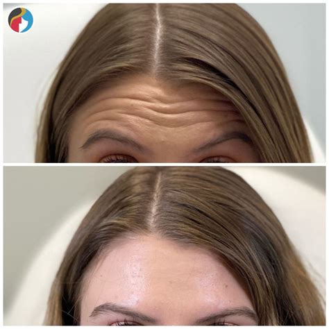 Botox Treatment | Syracuse, Albany, Rochester, New Hartford