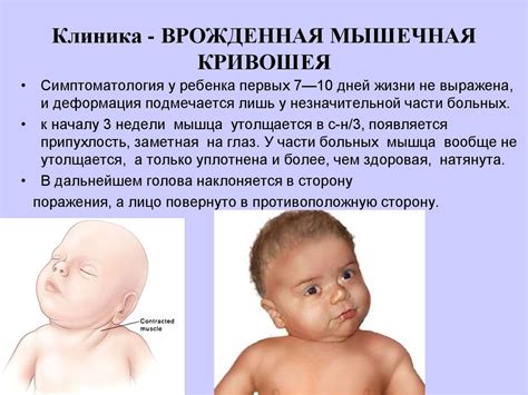 Кривошея - презентация онлайн
