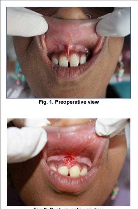 Figure 1 from MAXILLARY LABIAL FRENECTOMY USING 810nm DIODE LASER- A ...