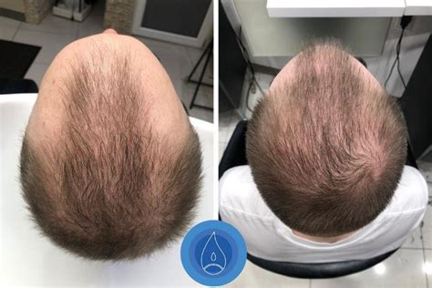 Hair loss treatment for all hair problems