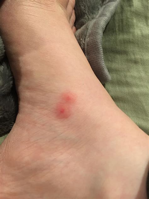 Bed Bug Bites Symptoms Medical Treatment at Charles Dunaway blog