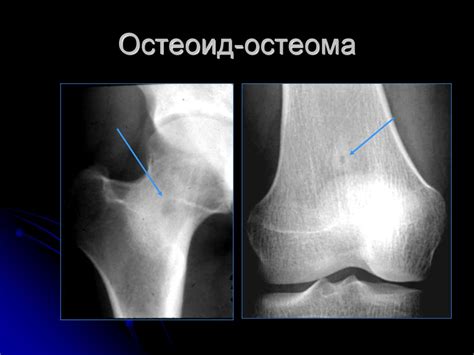 Лучевая диагностика опухолей опорно-двигательного аппарата ...