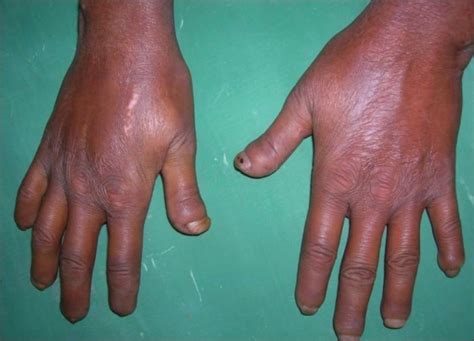 Sclerodactyly Causes