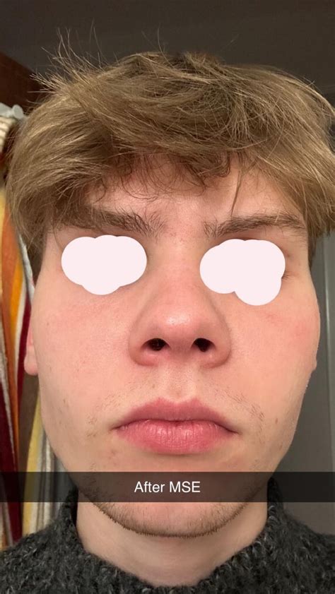 MSE before and after INSANE : r/orthotropics