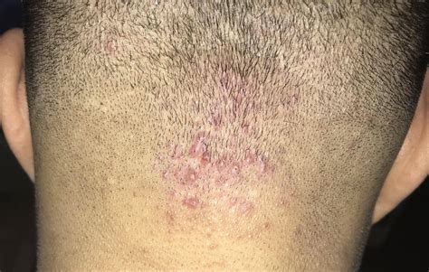 Mild Folliculitis Scalp Treatment