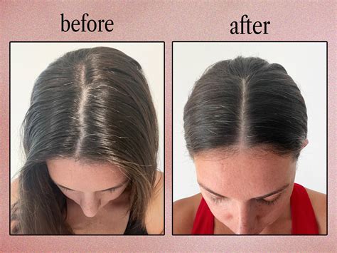 Is shea butter good for hair? The answer for dry scalp 1