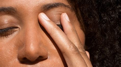 Periorbital Dermatitis Eyes