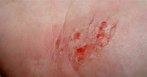 check  interesting facts  abrasions