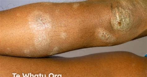 Discoid eczema image