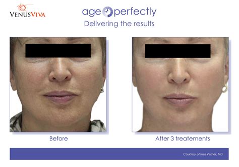 Venus Viva: Facial Remodeling & Resurfacing | Age Perfectly