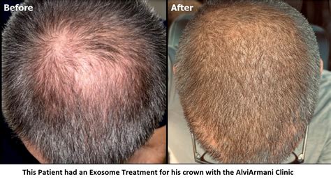 Exosome Hair Treatment - Alvi Armani Hair Transplant Beverly Hills, Los ...