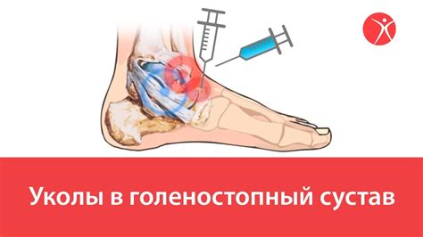 Уколы в голеностопный сустав - YouTube