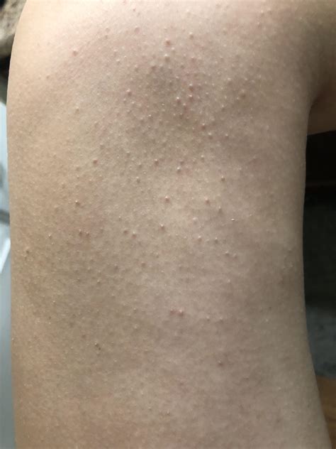rid  small bumps rplusskincare