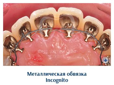 Элементы брекет-системы: ортодонтические кольца, дуга, лигатуры ...
