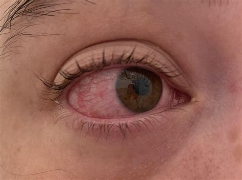 I was diagnosed with episcleritis. : r/Episcleritis