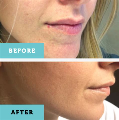 Tea tree cleanser - Face wash for oily skin - Eraorganics.com – Era ...