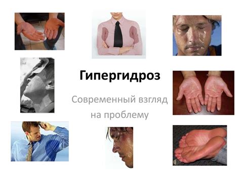 Гипергидроз. Современный взгляд на проблему - презентация онлайн