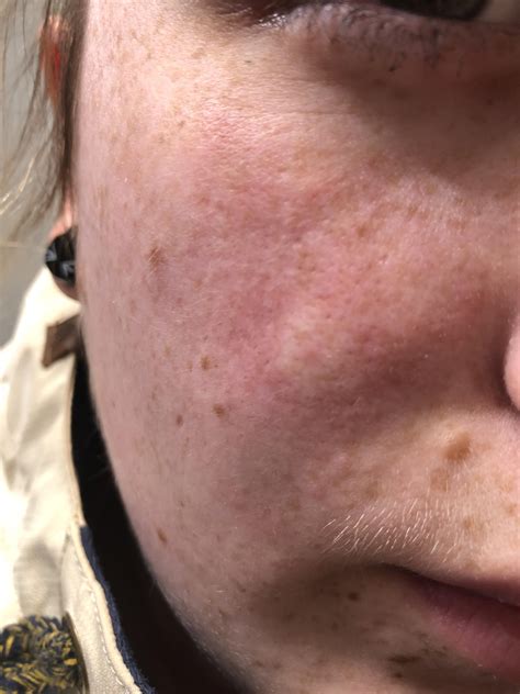 The secret pop cystic pimple dangers that dermatologists warn about