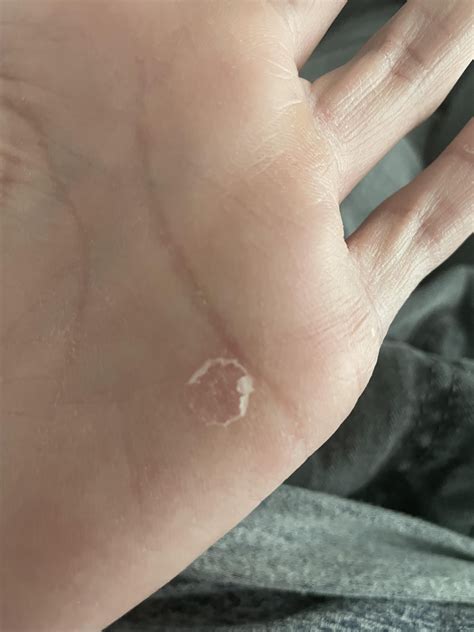 Is this a sign of it healing? Terbafine 1 week so far doc recommended 2