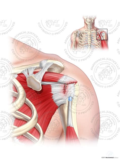 left supraspinatus  subscapularis tears  text