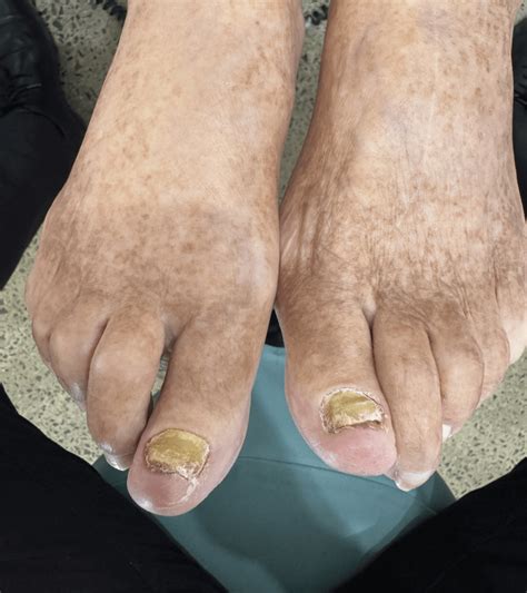 Fungal Nail Laser Treatment