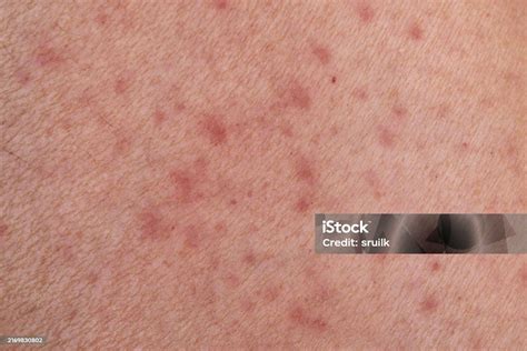 human skin showing symptoms  chronic skin disease stock photo