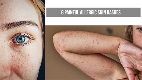 8 Painful Skin Rashes: Recognize & Get Relief Now