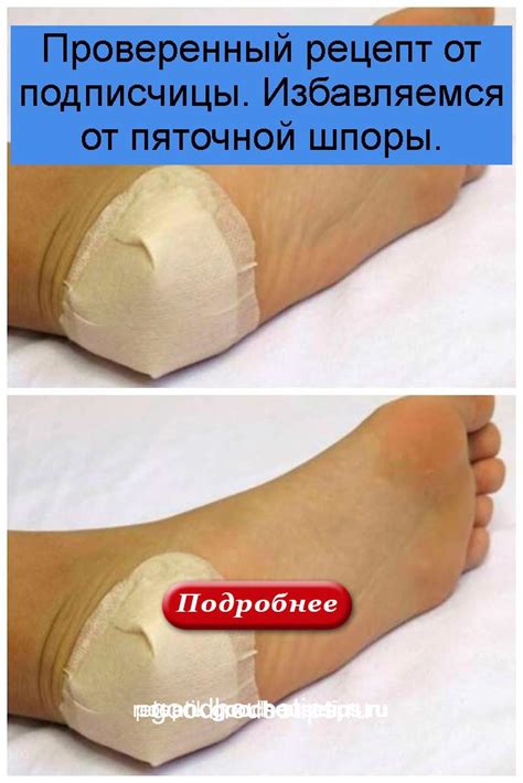 Проверенный рецепт от подписчицы. Избавляемся от пяточной шпоры.