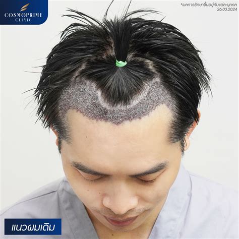 Male Pattern Hair Loss: Understanding Hormone-Induced Hair Thinning