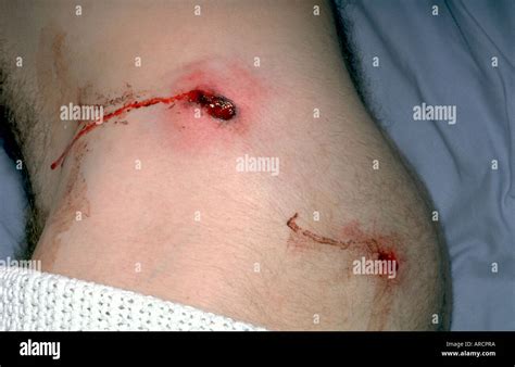 gunshot bullet wound  res stock photography  images alamy