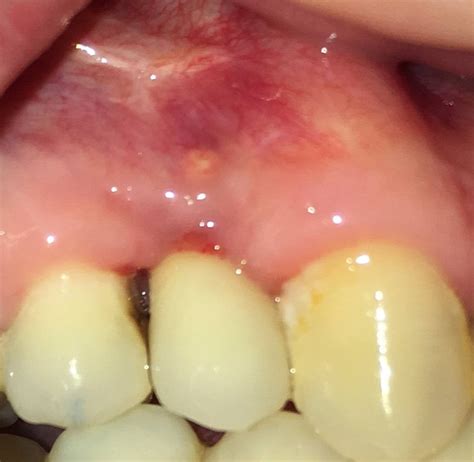 dental implant bleeding  weeks  placement rdentistry