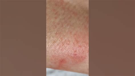 Mango allergy #Allergy #Rash - YouTube
